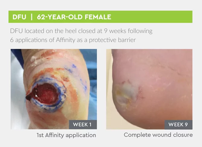 DFU located on the heel closed at 9 weeks following 6 applications of Affinity